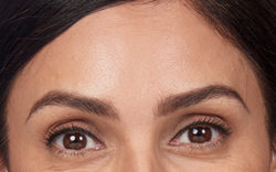 Alexandra's forehead lines after botox