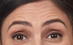 Alexandra's forehead lines before botox
