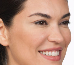 Cynthia after botox treatment for crow's feet
