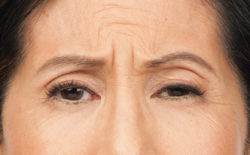 Susan 's frown before botox