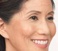 Susan before botox treatment for crow's feet